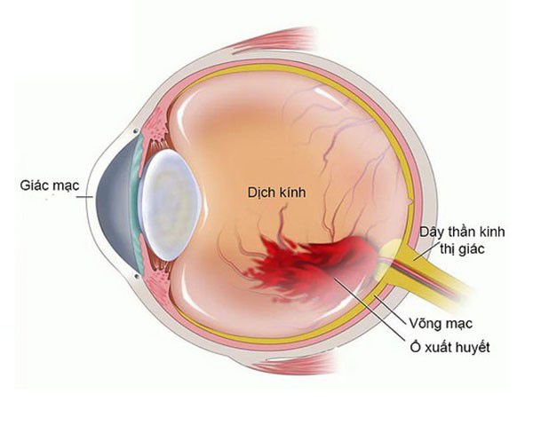  Soi ánh đồng tử: nhìn thấy dịch kính đục, nhiều mảng máu di chuyển trong dịch kính